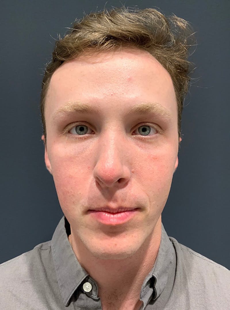 Nose Before & After Gallery - Patient 189964358 - Image 3