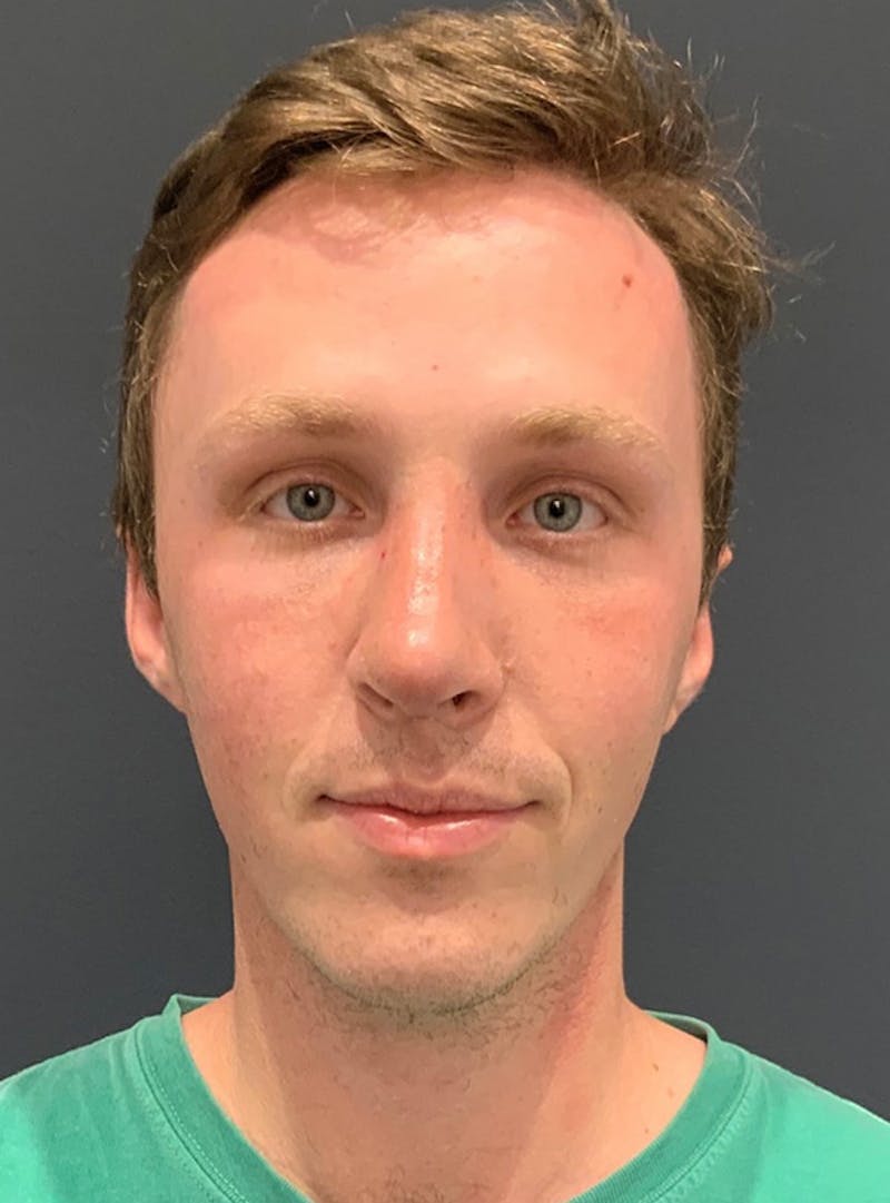 Nose Before & After Gallery - Patient 189964358 - Image 4