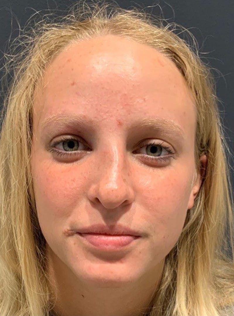 Nose Before & After Gallery - Patient 189964436 - Image 3