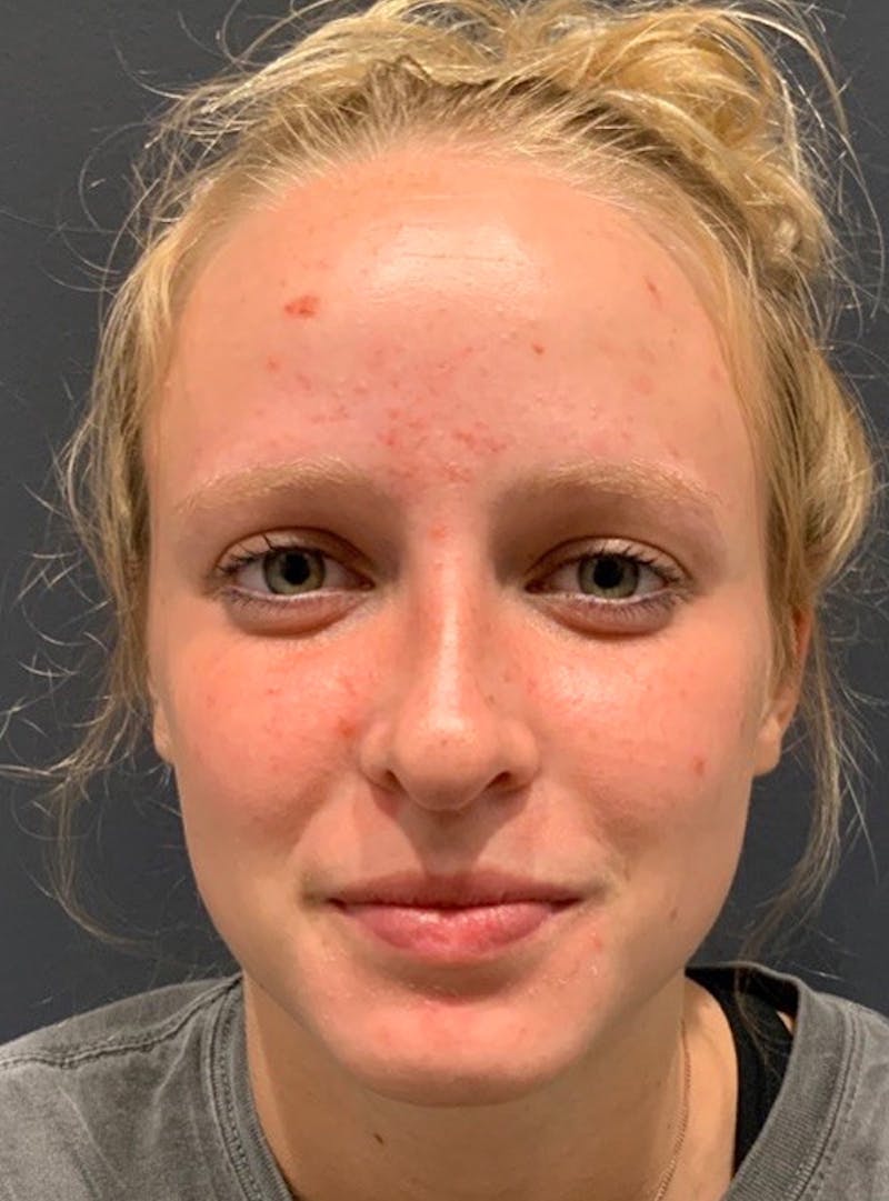 Nose Before & After Gallery - Patient 189964436 - Image 4