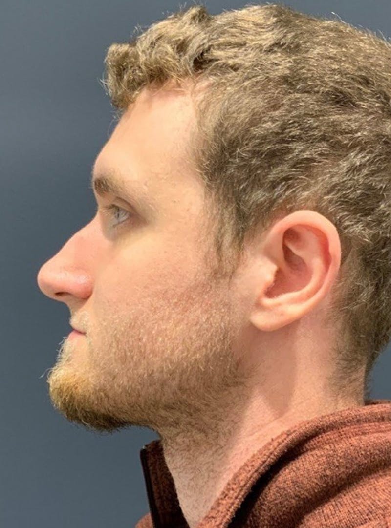Nose Before & After Gallery - Patient 189964480 - Image 5