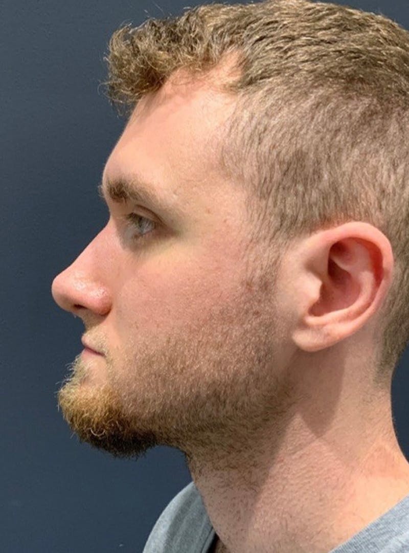 Nose Before & After Gallery - Patient 189964480 - Image 6