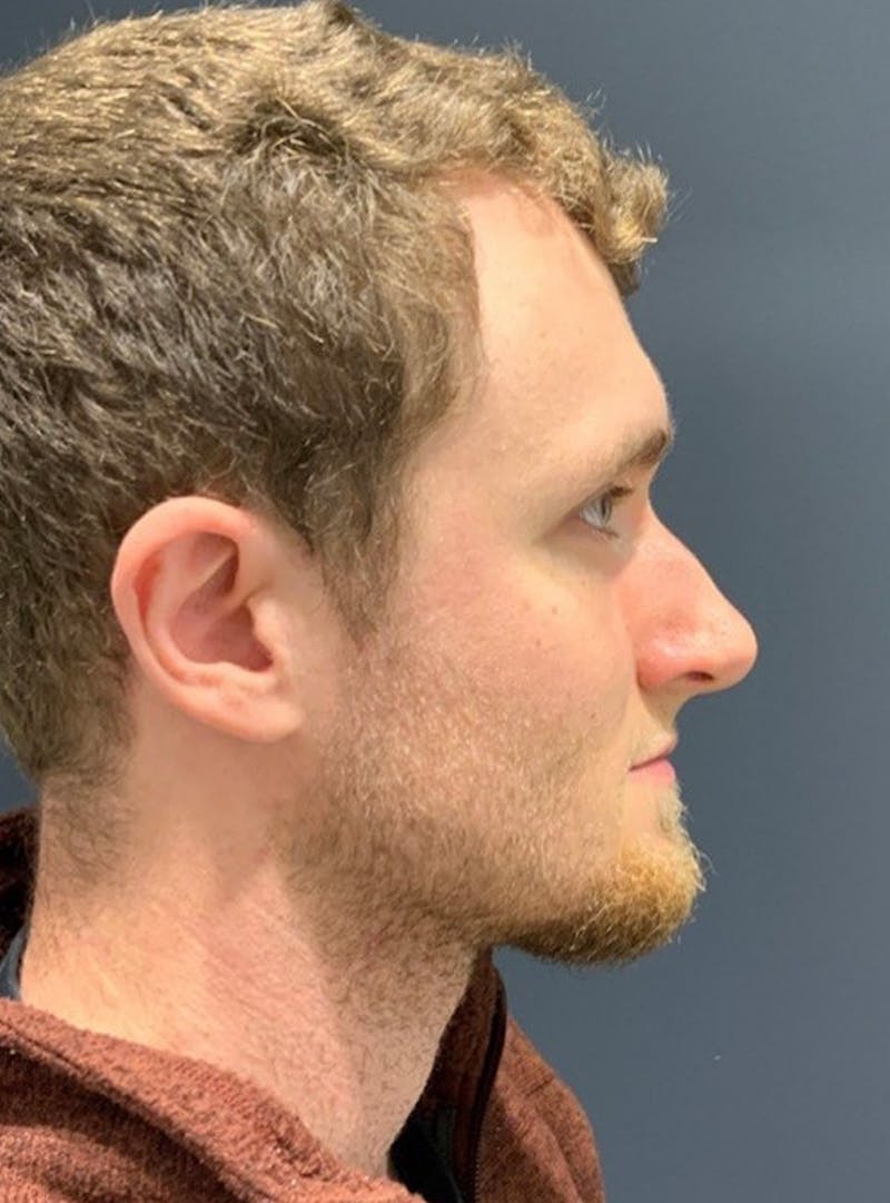 Nose Before & After Gallery - Patient 189964480 - Image 1