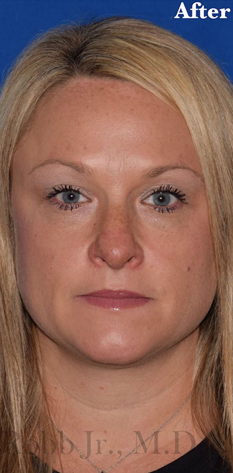 Nose Before & After Gallery - Patient 189964522 - Image 2