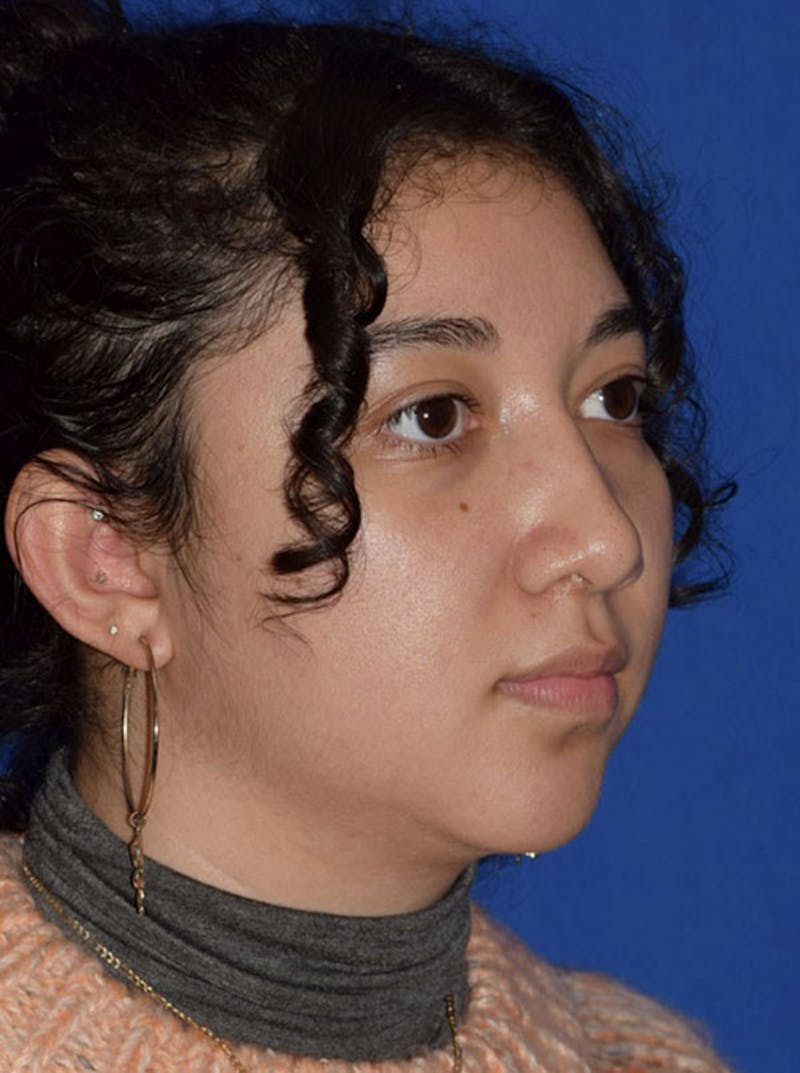 Nose Before & After Gallery - Patient 189964670 - Image 4