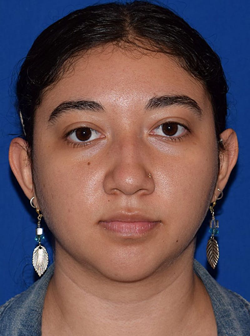 Nose Before & After Gallery - Patient 189964670 - Image 5