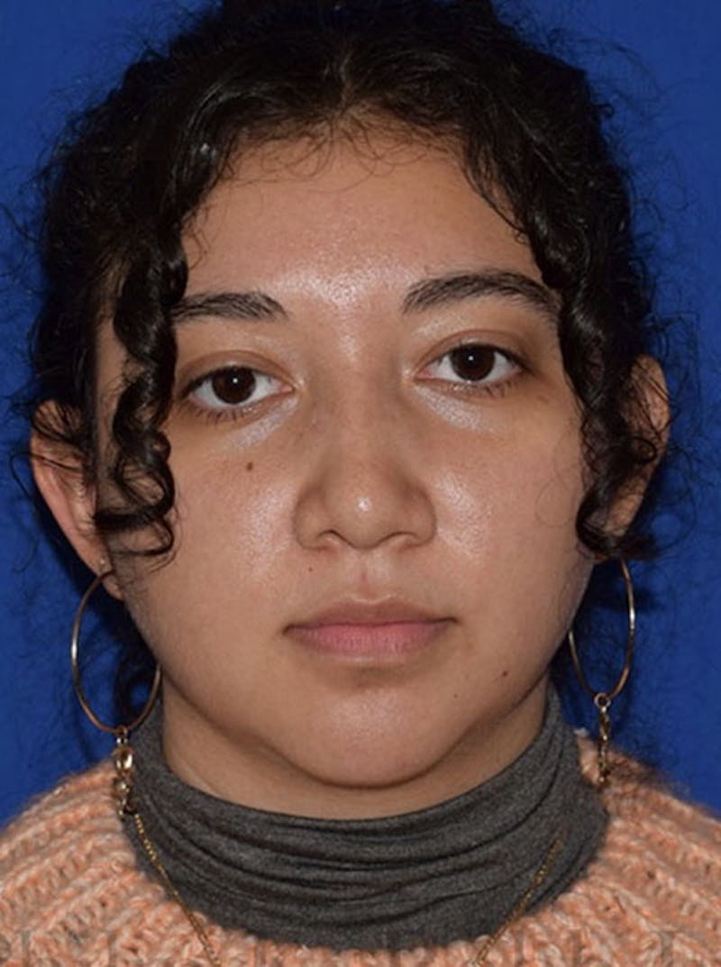 Nose Before & After Gallery - Patient 189964670 - Image 6