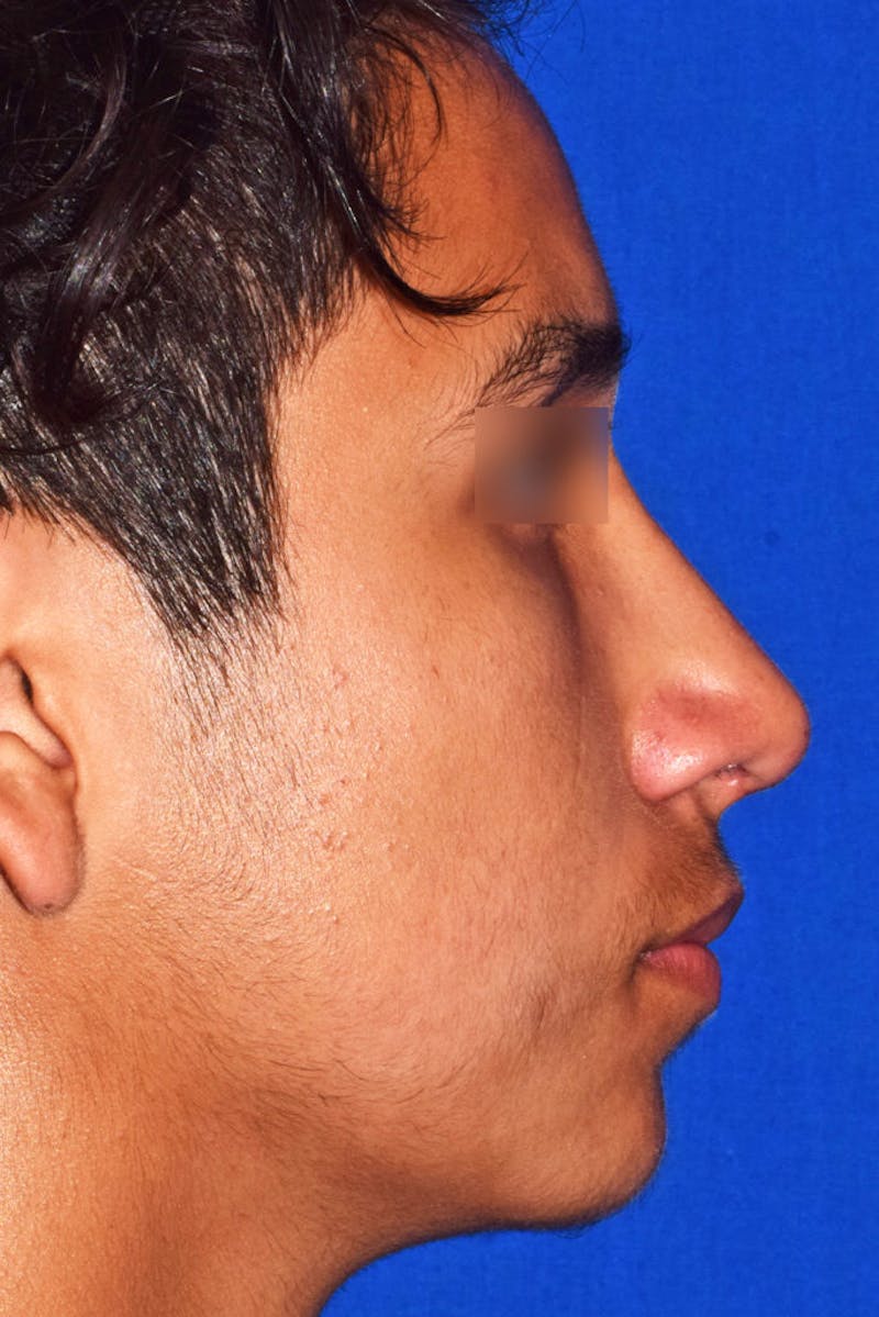 Nose Before & After Gallery - Patient 189964710 - Image 2