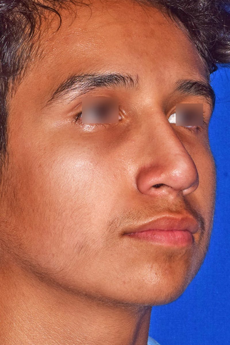 Nose Before & After Gallery - Patient 189964710 - Image 4