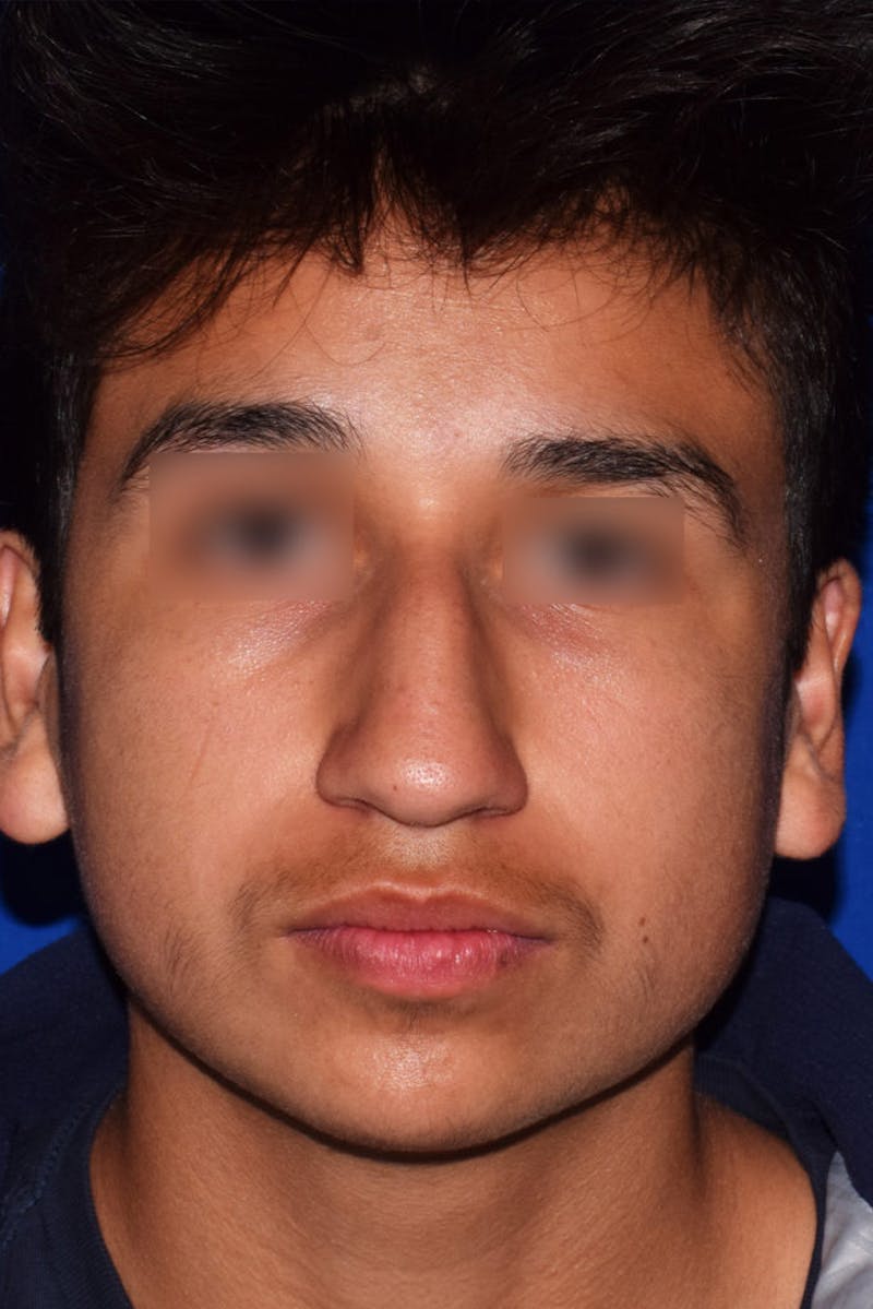 Nose Before & After Gallery - Patient 189964710 - Image 5