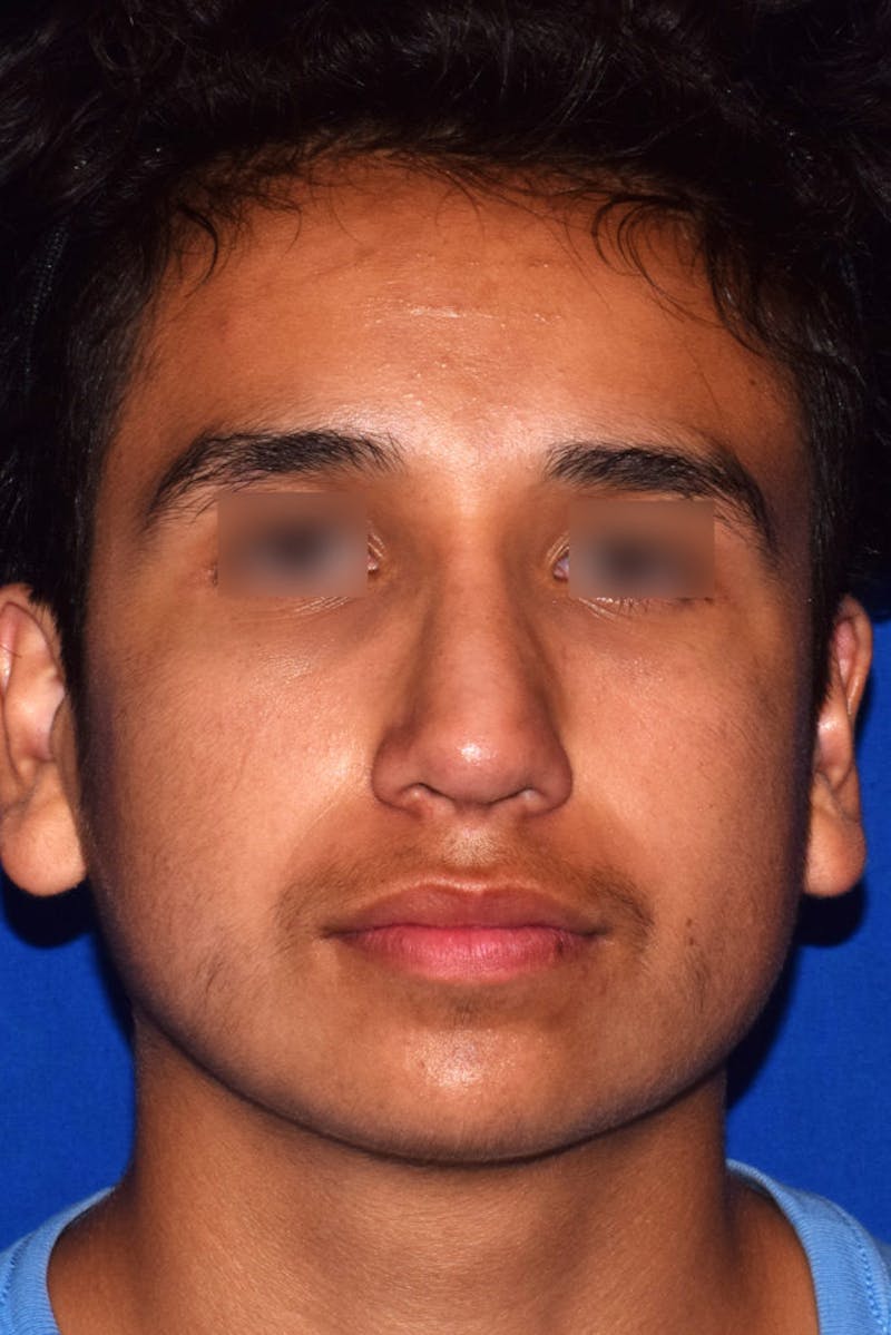 Nose Before & After Gallery - Patient 189964710 - Image 6