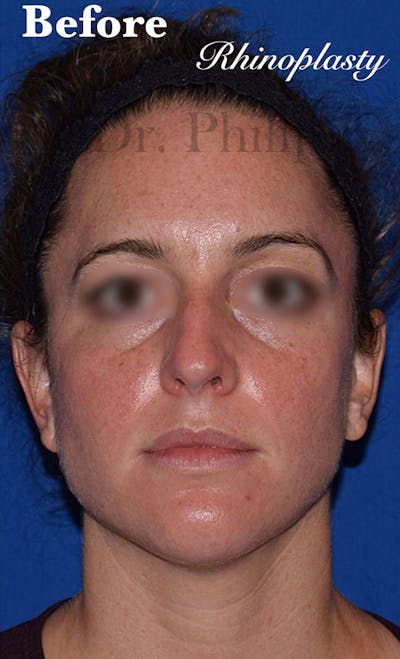 Nose Before & After Gallery - Patient 189964719 - Image 1