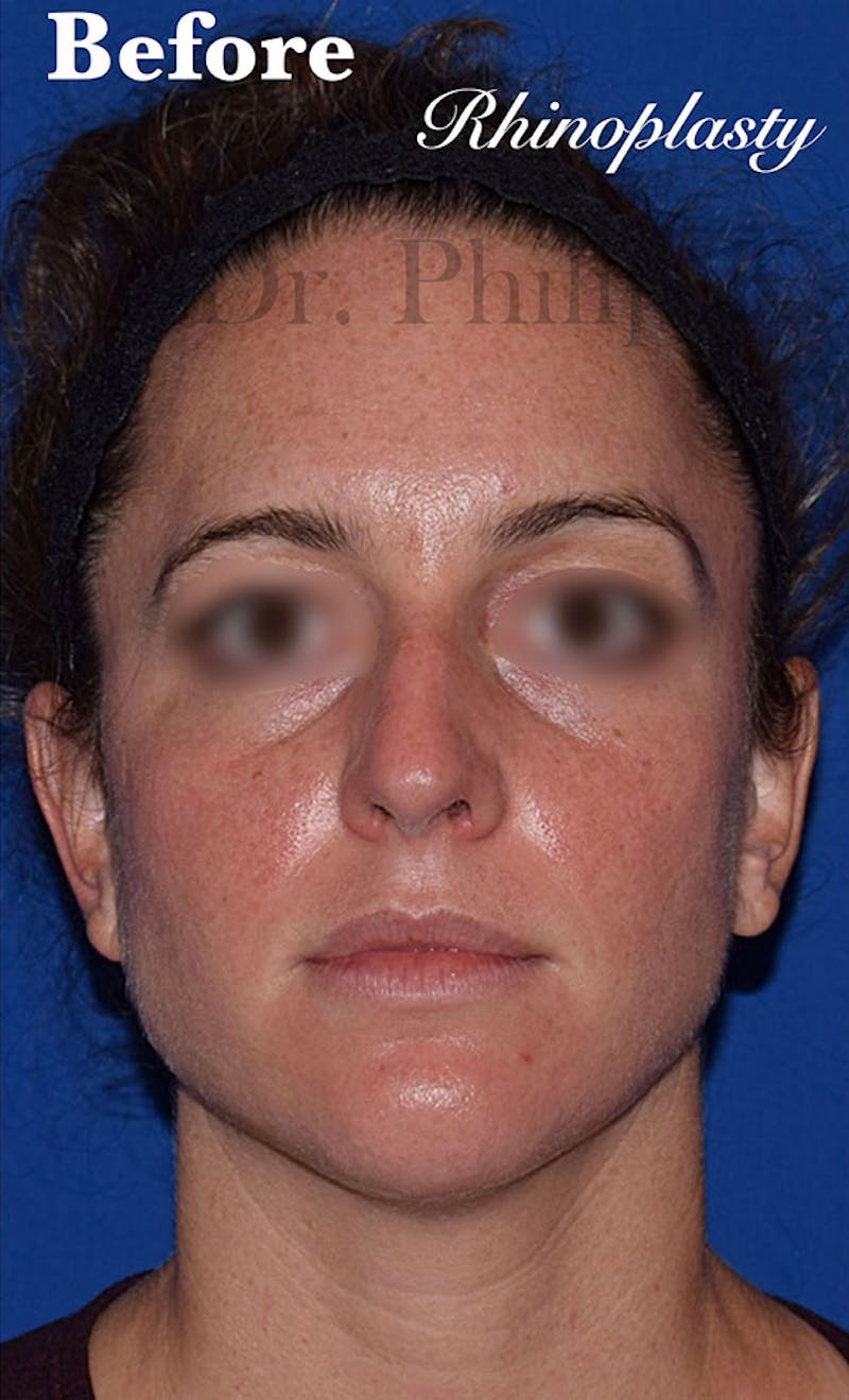 Nose Before & After Gallery - Patient 189964719 - Image 1