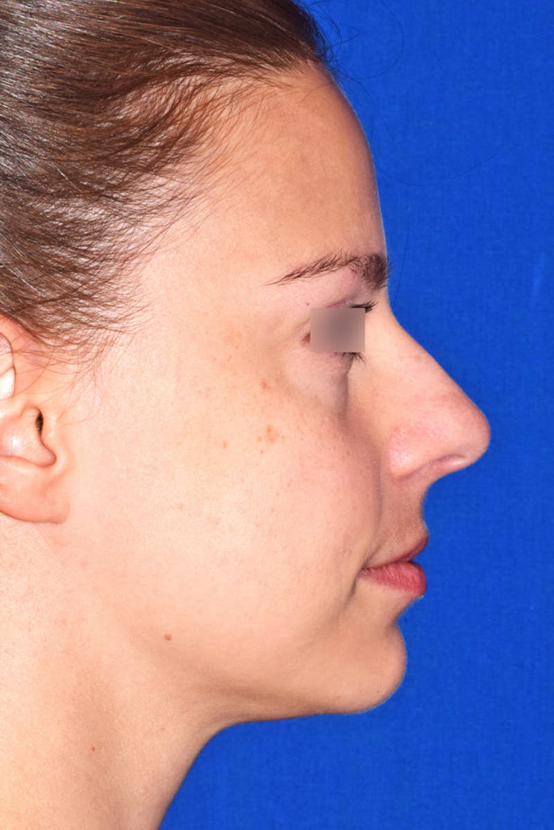 Nose Before & After Gallery - Patient 189964720 - Image 1