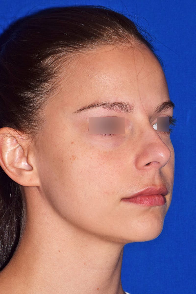 Nose Before & After Gallery - Patient 189964720 - Image 3