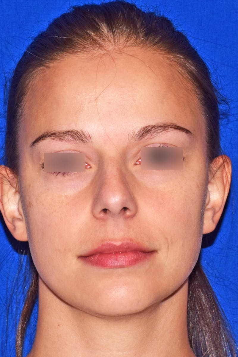 Nose Before & After Gallery - Patient 189964720 - Image 5