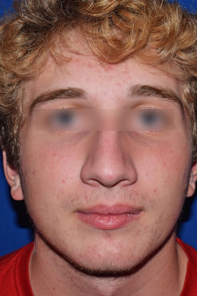 Nose Before & After Gallery - Patient 189964721 - Image 5