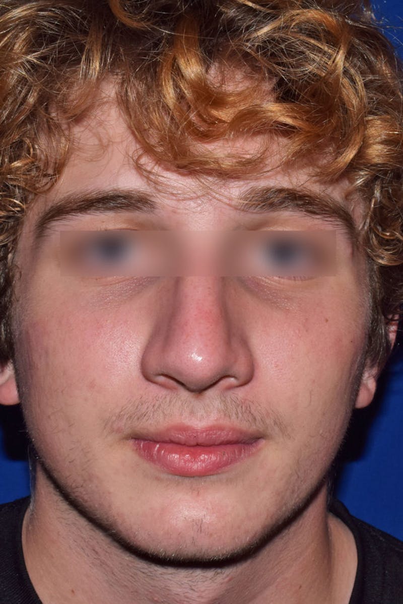 Nose Before & After Gallery - Patient 189964721 - Image 6