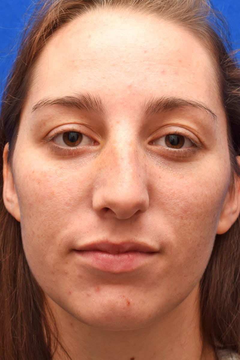 Nose Before & After Gallery - Patient 189964722 - Image 5