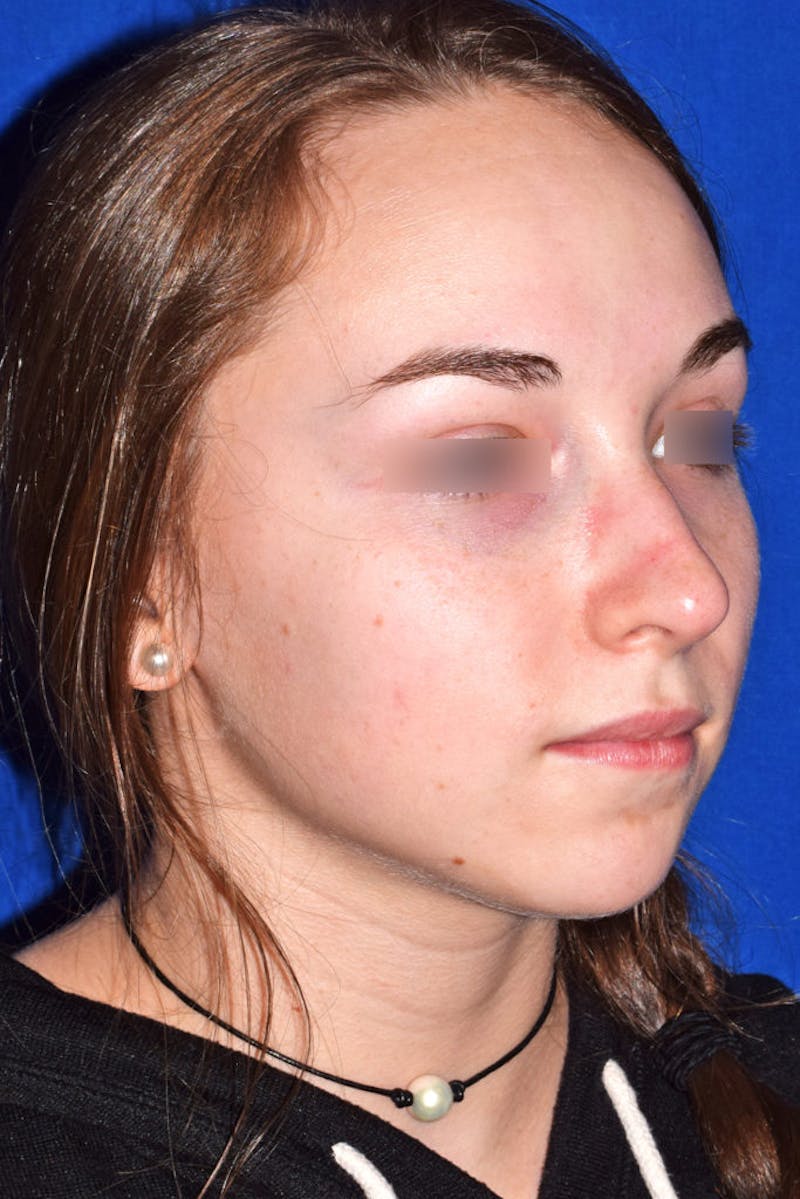 Nose Before & After Gallery - Patient 189964723 - Image 3