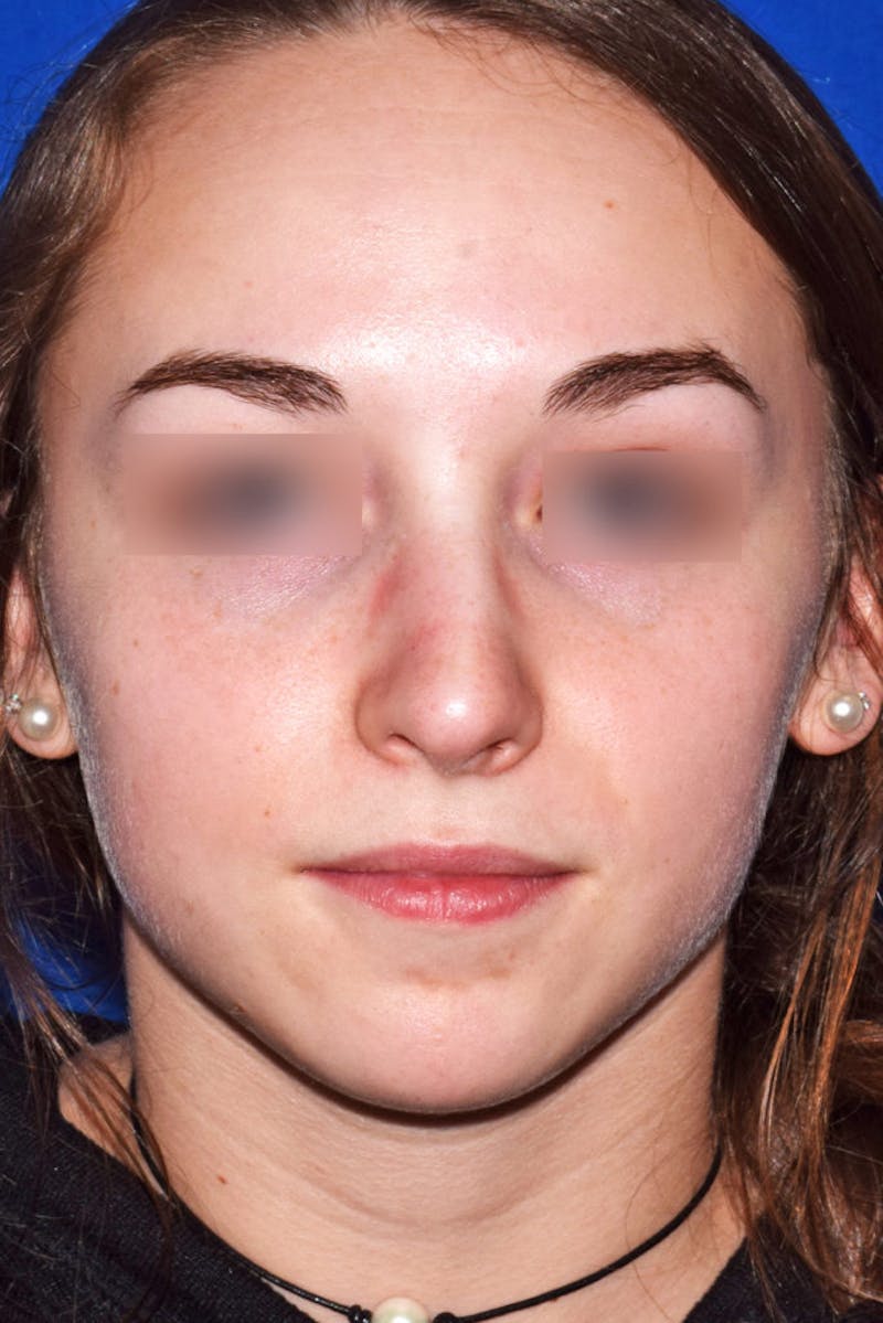 Nose Before & After Gallery - Patient 189964723 - Image 5
