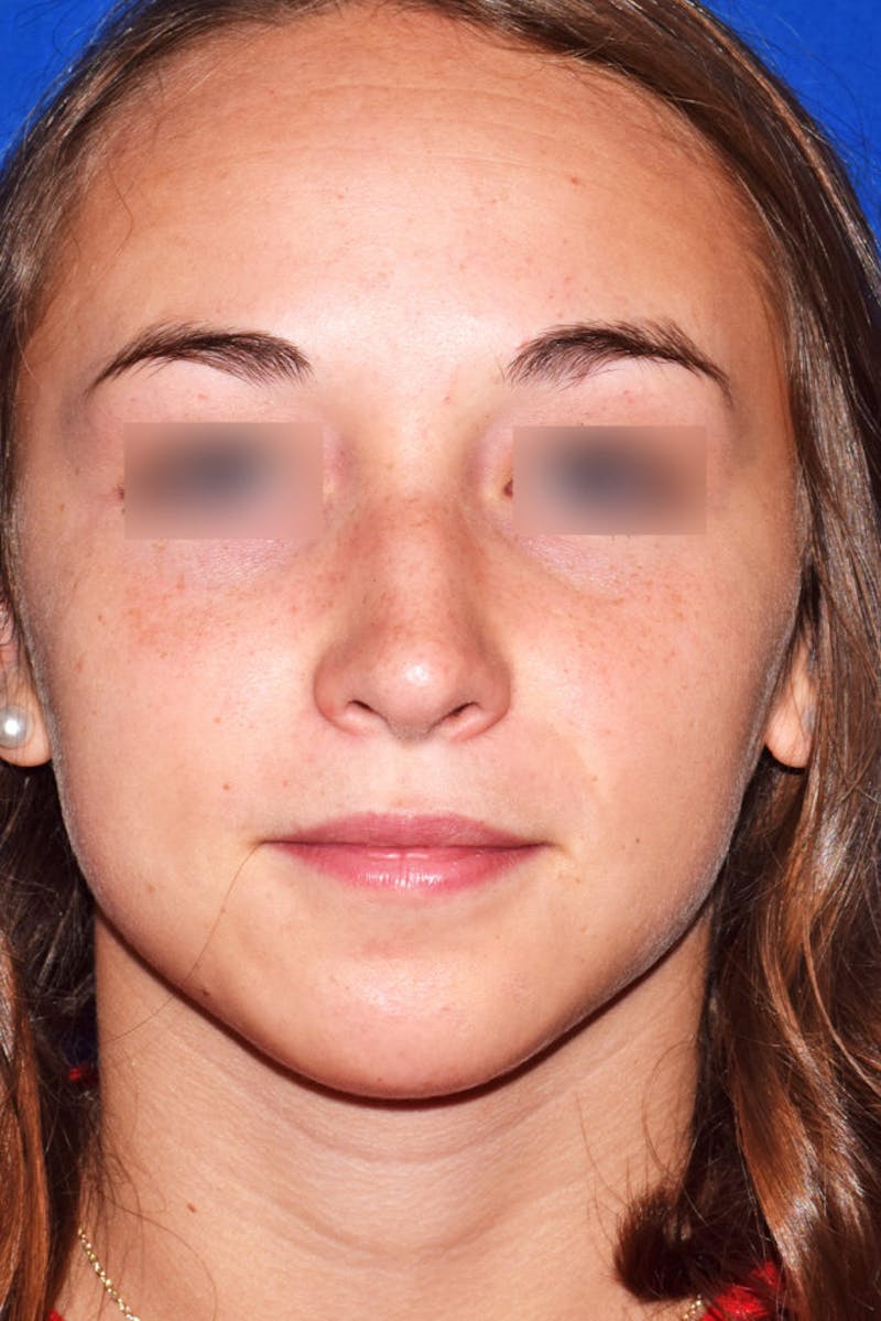 Nose Before & After Gallery - Patient 189964723 - Image 6