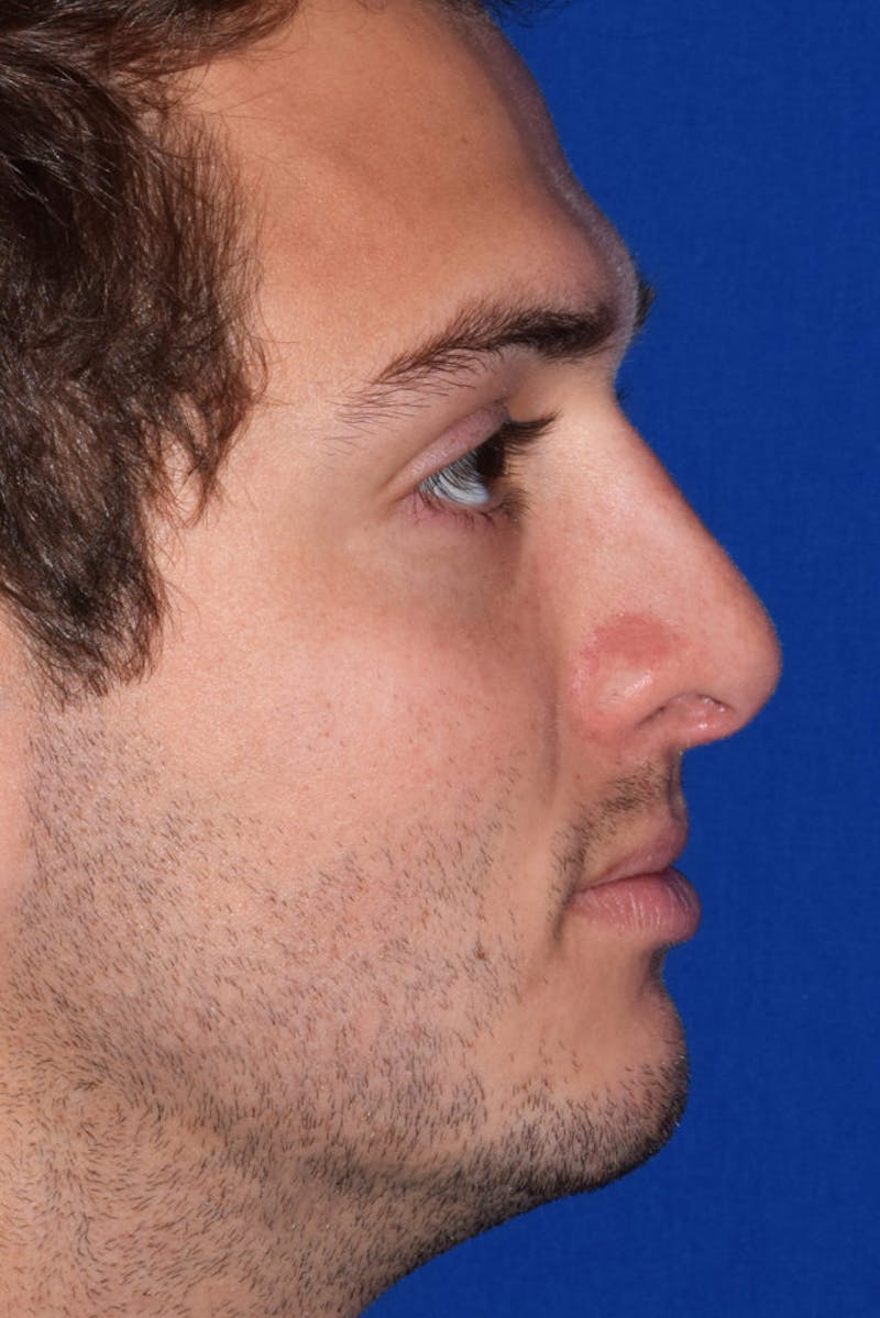 Nose Before & After Gallery - Patient 189964726 - Image 2