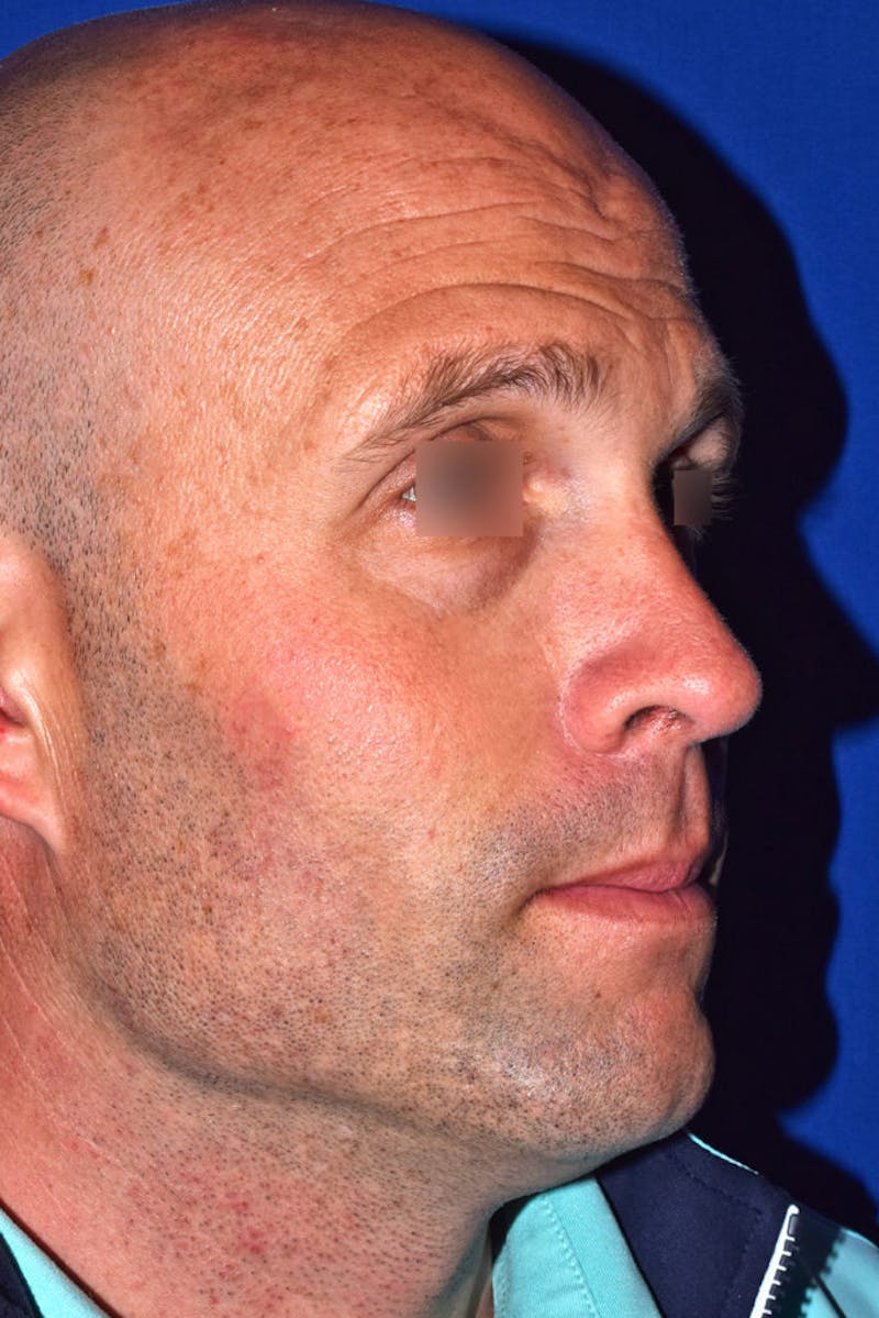 Nose Before & After Gallery - Patient 189964778 - Image 4