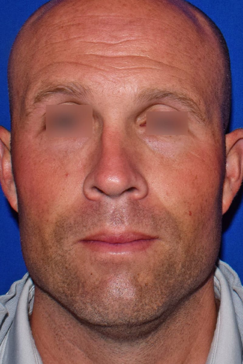 Nose Before & After Gallery - Patient 189964778 - Image 5
