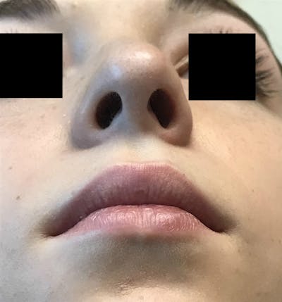 Nose Before & After Gallery - Patient 189964786 - Image 2