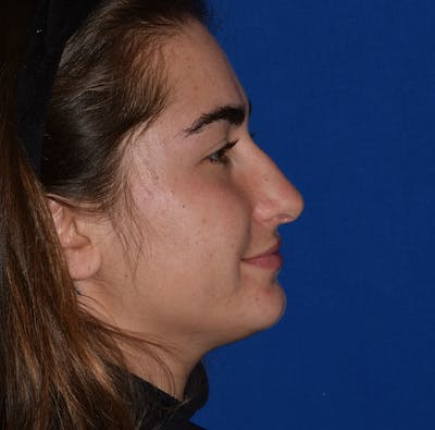 Nose Before & After Gallery - Patient 189964789 - Image 2