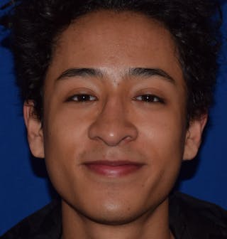 Nose Before & After Gallery - Patient 189964858 - Image 4