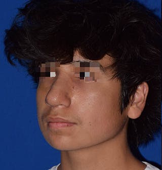 Nose Before & After Gallery - Patient 189964900 - Image 4