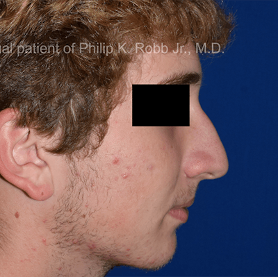 Nose Before & After Gallery - Patient 189964926 - Image 1