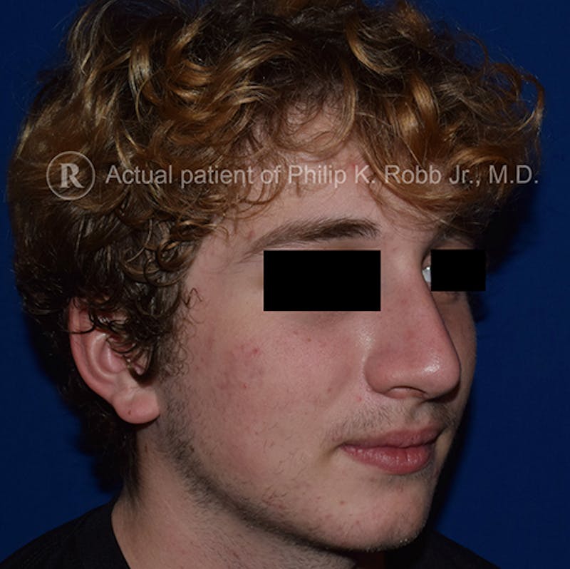 Nose Before & After Gallery - Patient 189964926 - Image 4