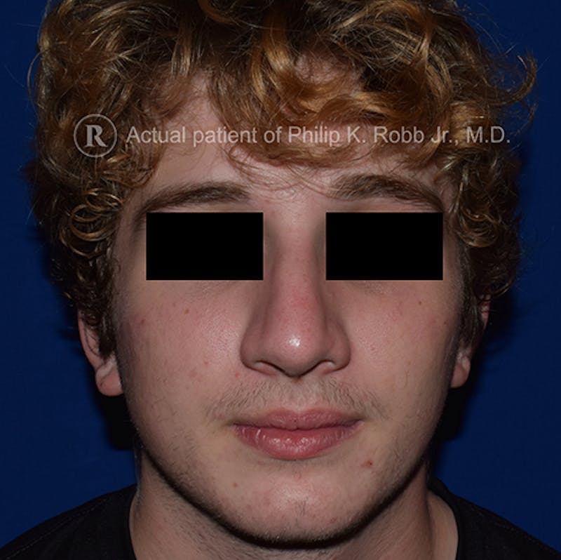 Nose Before & After Gallery - Patient 189964926 - Image 6