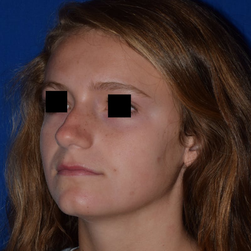 Nose Before & After Gallery - Patient 189964927 - Image 3