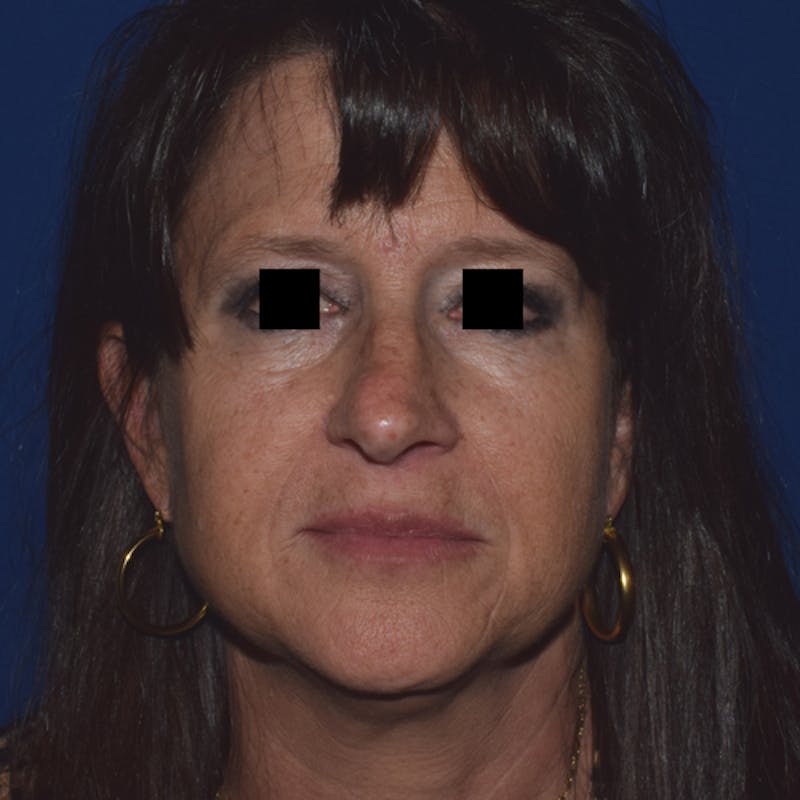 Nose Before & After Gallery - Patient 189964928 - Image 3