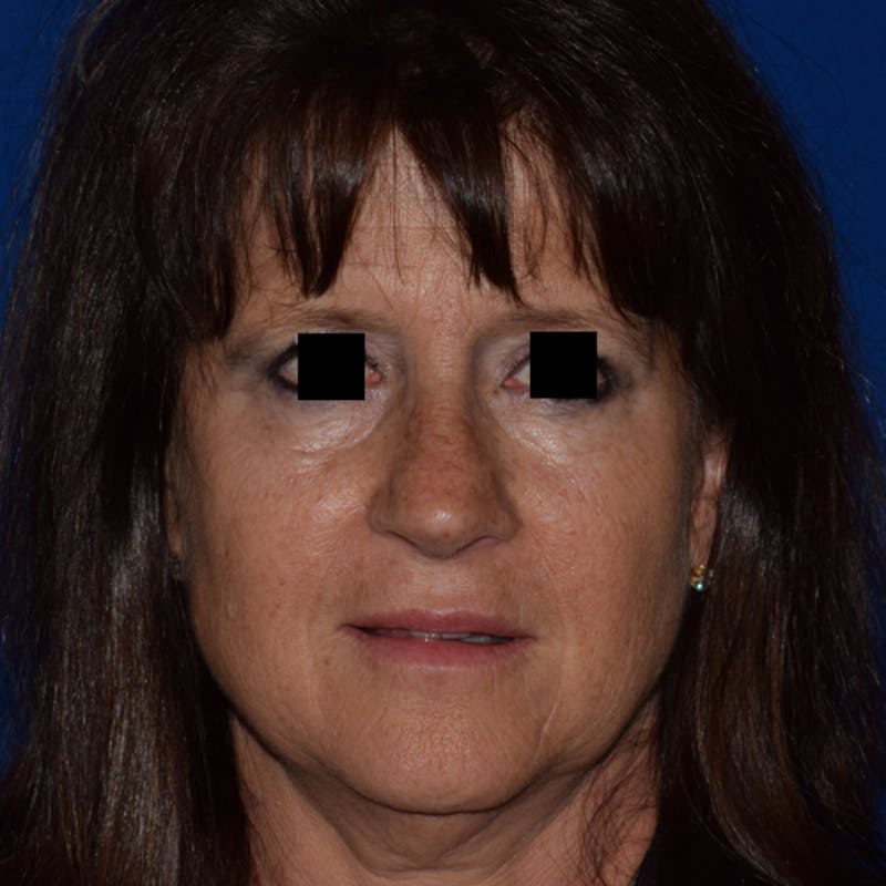 Nose Before & After Gallery - Patient 189964928 - Image 4