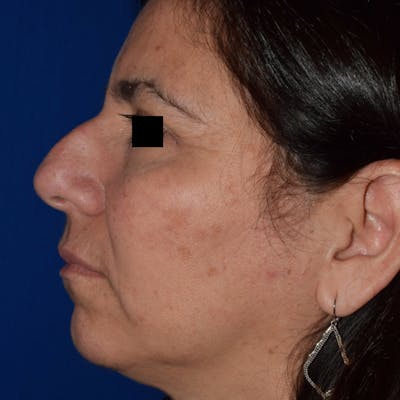 Nose Before & After Gallery - Patient 189965050 - Image 1