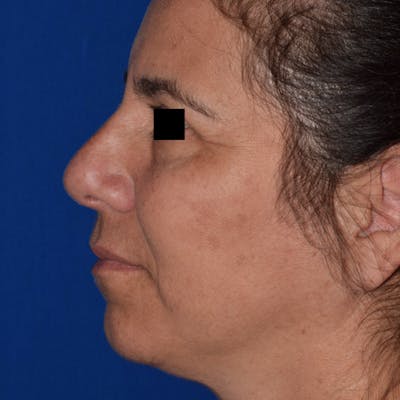 Nose Before & After Gallery - Patient 189965050 - Image 2