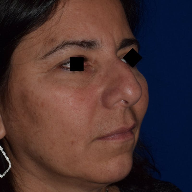 Nose Before & After Gallery - Patient 189965050 - Image 3