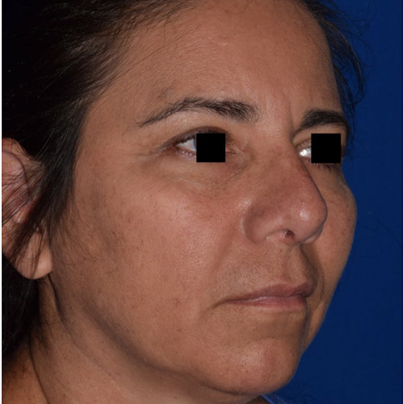 Nose Before & After Gallery - Patient 189965050 - Image 4