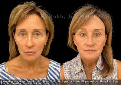 Face Before & After Gallery - Patient 205219843 - Image 1