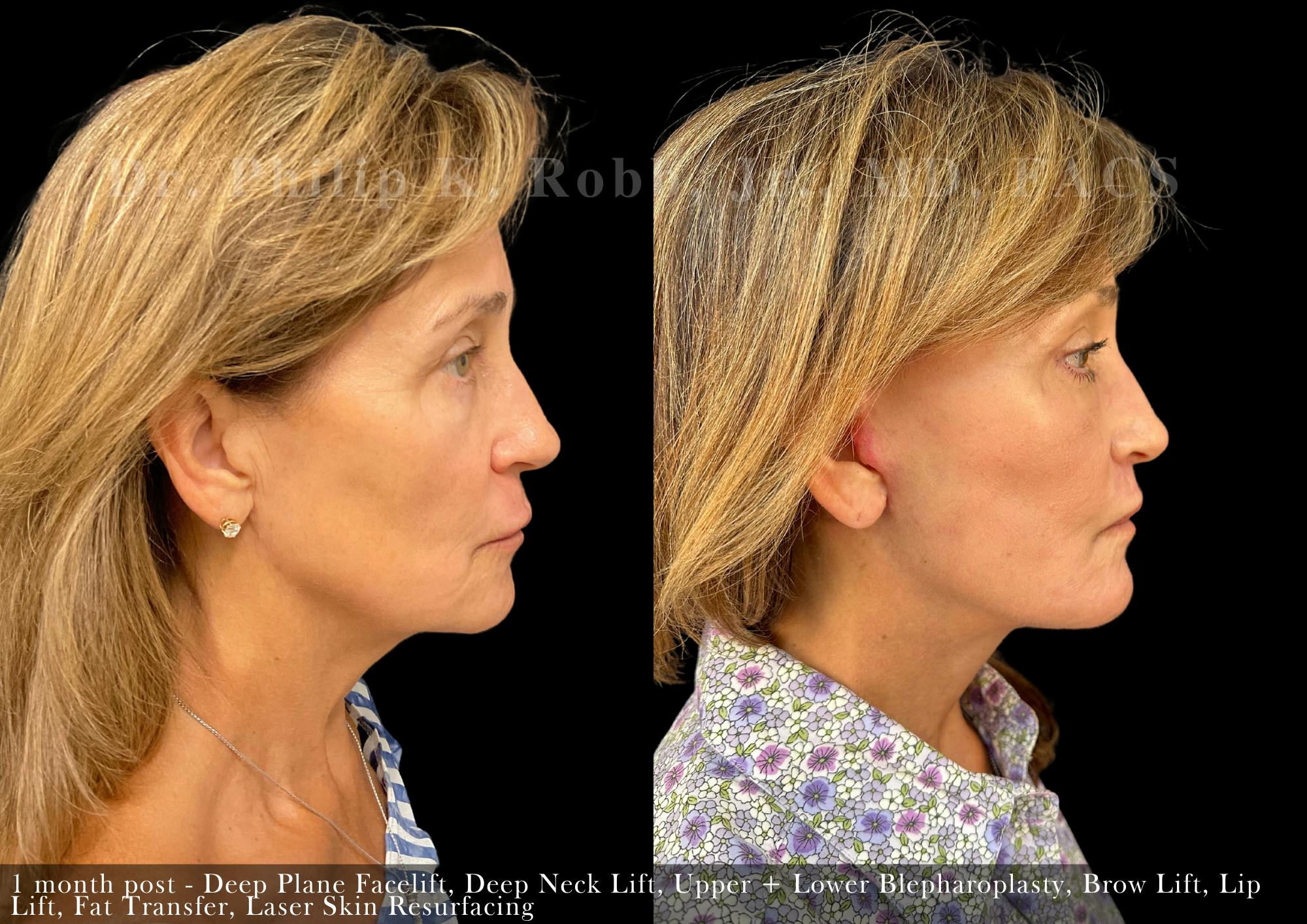 Face Before & After Gallery - Patient 205219843 - Image 3