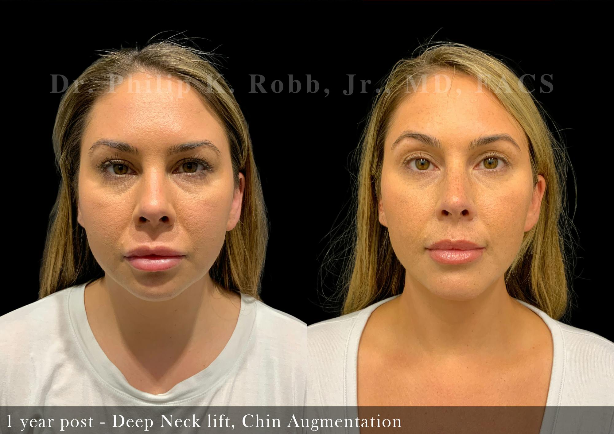 Face Before & After Gallery - Patient 205219846 - Image 3