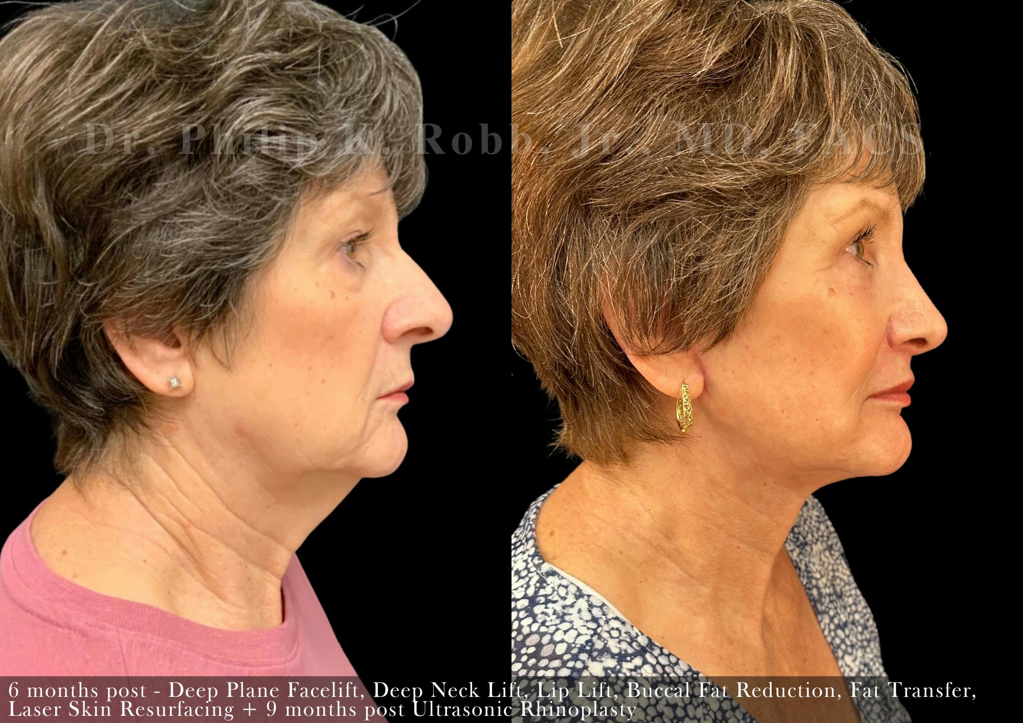 Non-Surgical Before & After Gallery - Patient 205217076 - Image 2