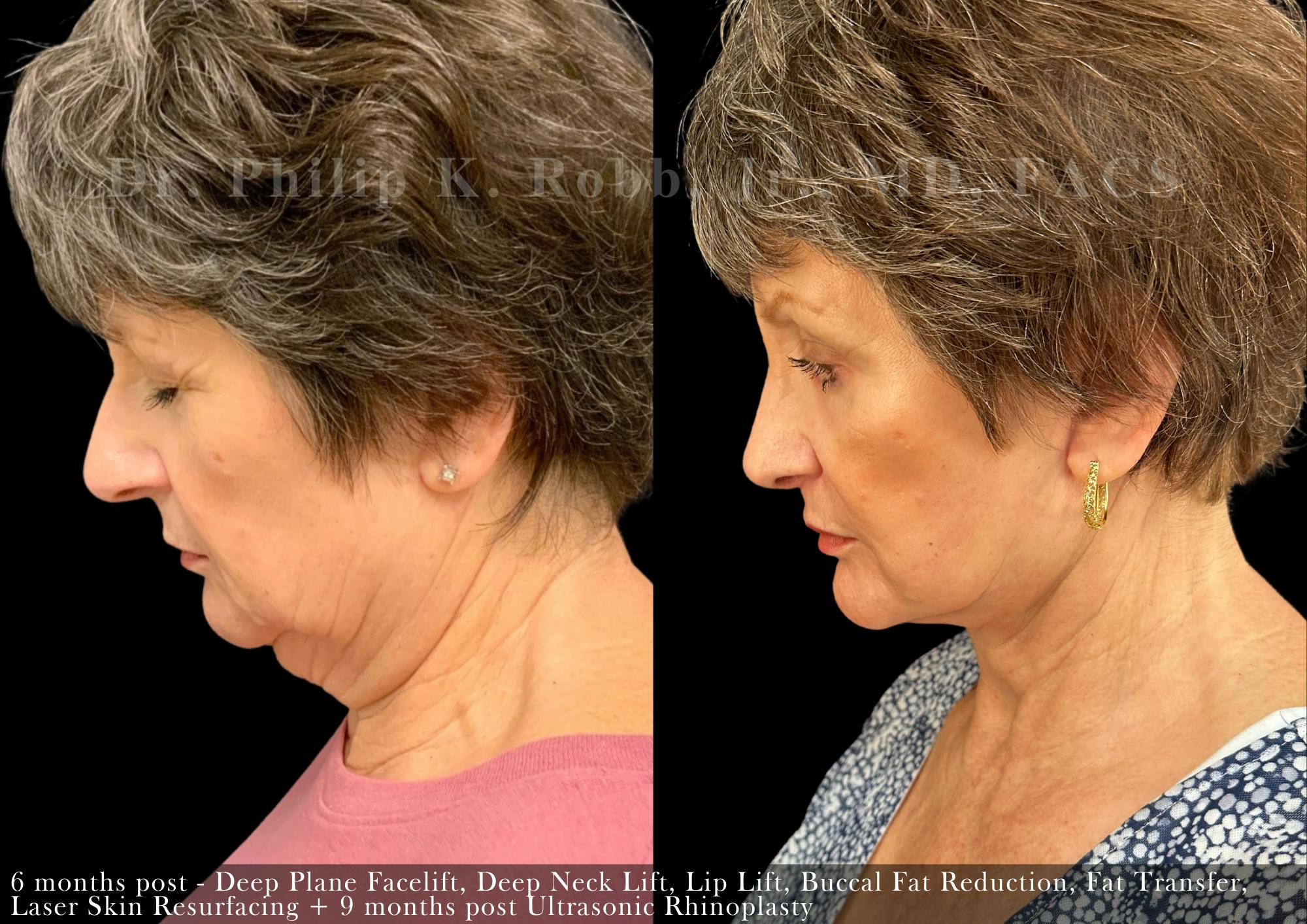 Non-Surgical Before & After Gallery - Patient 205217076 - Image 6