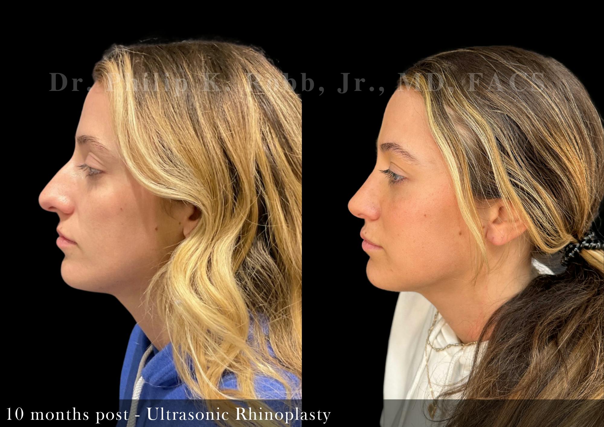 Nose Before & After Gallery - Patient 206361386 - Image 4