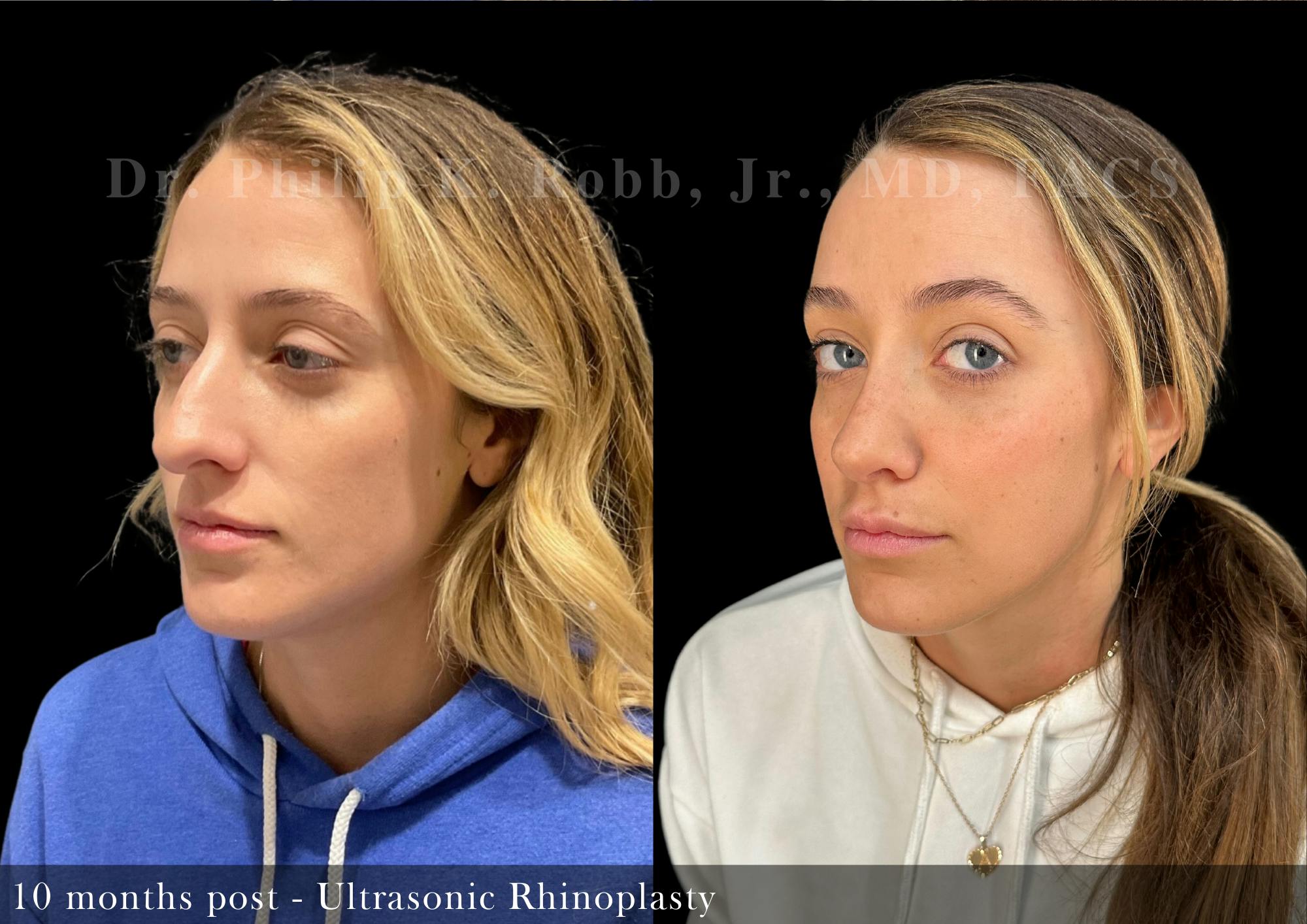 Nose Before & After Gallery - Patient 206361386 - Image 5